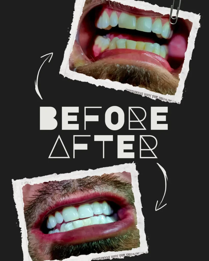 teeth whetening before after 1