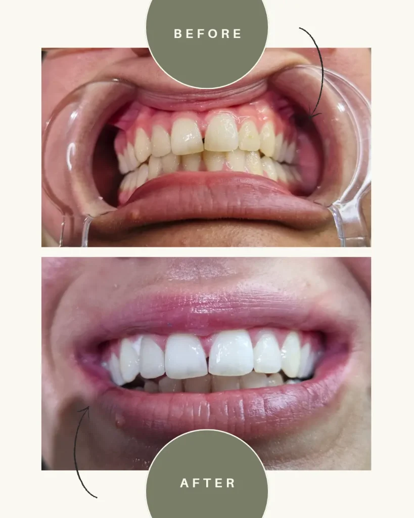 teeth whitening before after 2