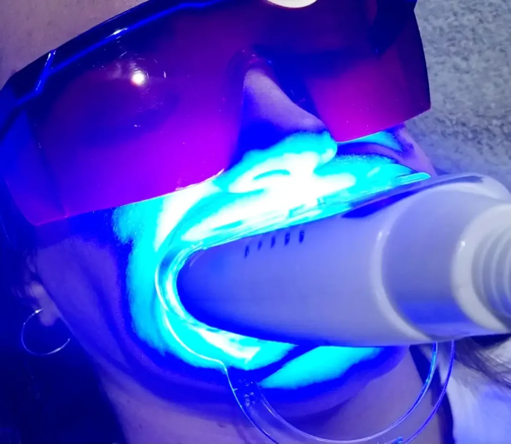 teeth whitening procedure 2